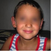 Operar orejas de soplillo en niños en Barcelona   despues