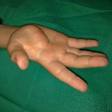 Hand tumor: before