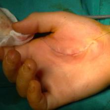 Hand tumor: after